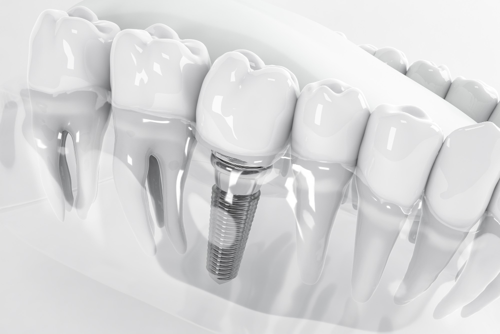 dental implants mount pleasant tx